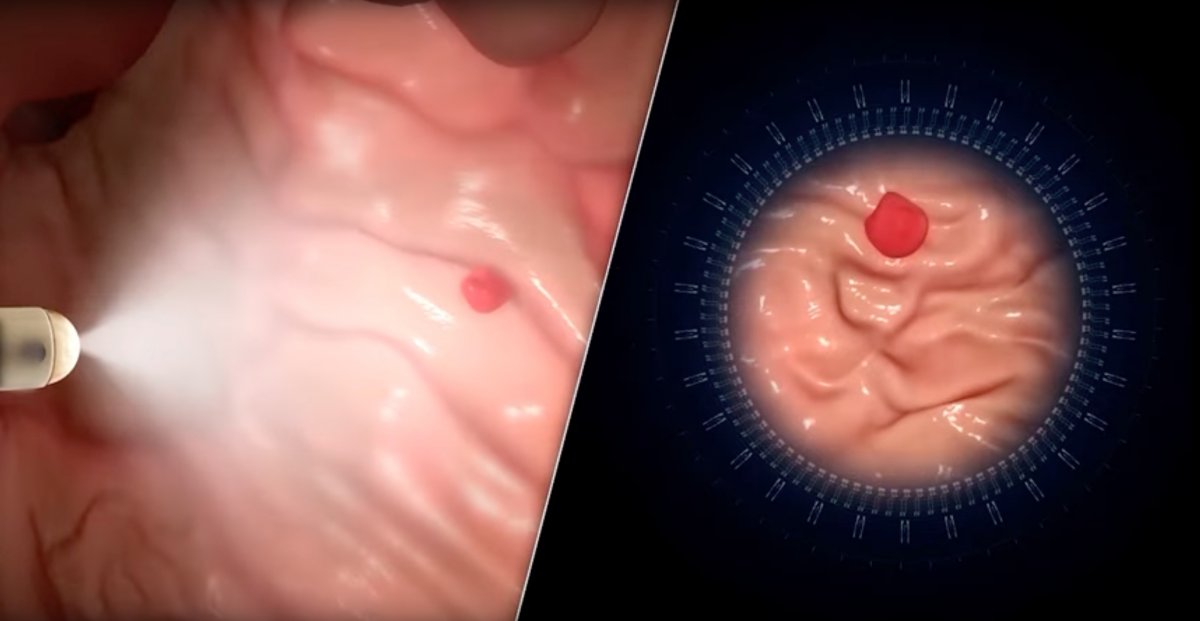 NaviCam: Magnetically controlled robotic capsule camera can replace endoscopy