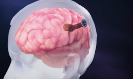 Revolutionary Brain Implant: Five Times Thinner than a Human Hair